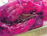 Fir tree grows inside man?s lungs