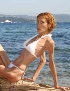 Anorexic model Isabelle Caro died after hospitalization