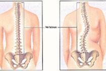 Krasnoyarsk doctors developed new method of scoliosis treatment